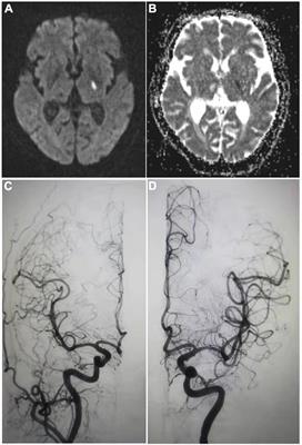 Clinical safety and possible efficacy of tirofiban in combination with intravenous thrombolysis by recombinant tissue plasminogen activator for early treatment of capsular warning syndrome (CWS)